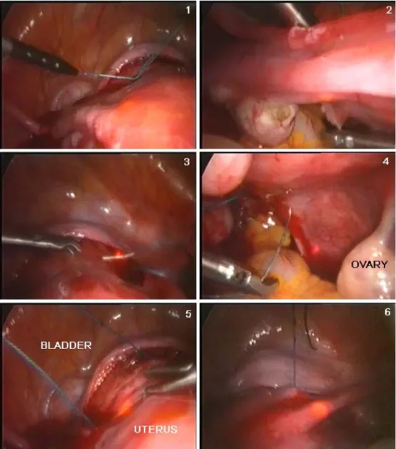 Fig. 1 The steps of laparo- laparo-scopic transabdominal isthmic cerclage
