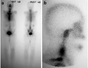Fig. 4 a, b. CT scan. a Ground-glass appearance of the lesion with minimal expansion (arrow)