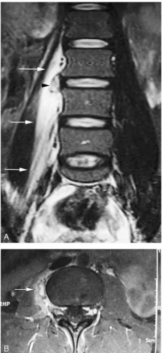 Fig. 2. CT scan obtained after MRI showing the characteristic features of myositis ossificans