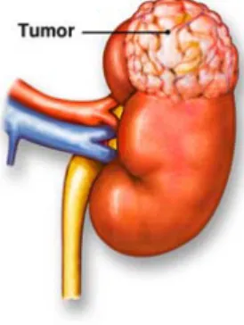 Figure 1 shows a tumor in a kidney [6] with the parameters  listed below: 
