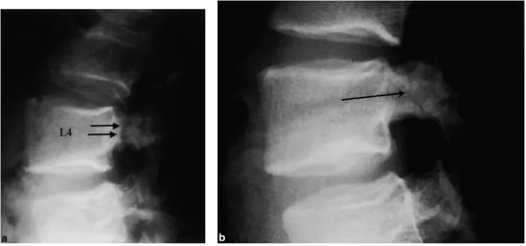 Fig. 1. Case 1: Lateral radiographs of lumbar spine at initial presentation (a) and after conservative treatment (b)