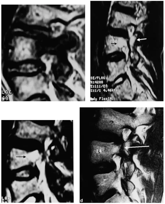 Fig. 2. Case 1: MR examination. (a) Sagittal T1-weighted image shows the nonspecific edema in the right L4 pedicle