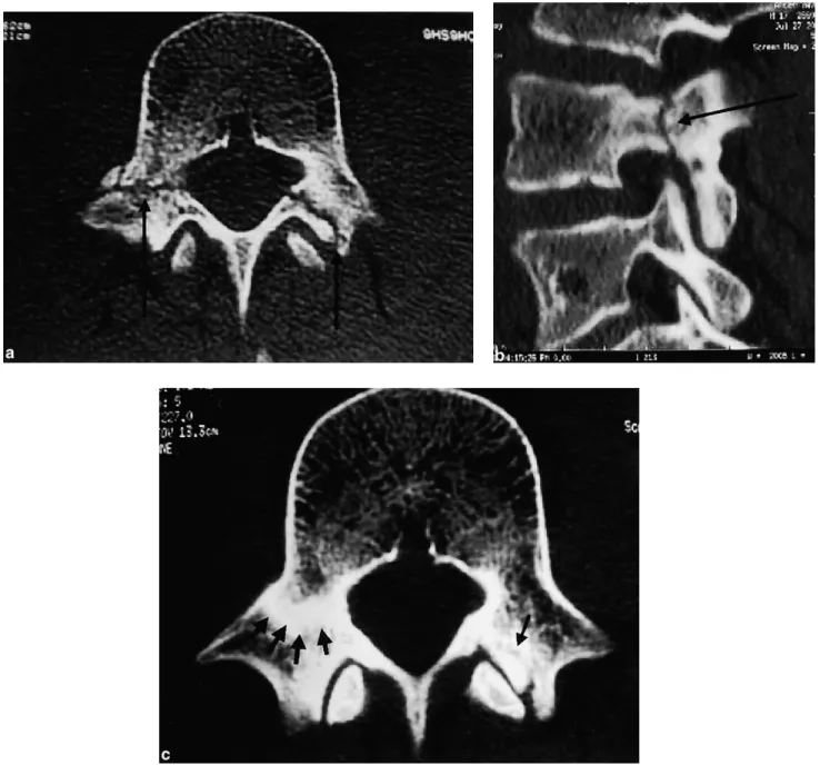 Fig. 3. Case 1: (a) Axial CT scan reveals both right pedicular and left pars interarticularis fractures (arrows)