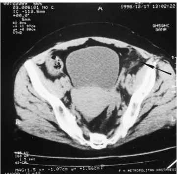Fig. 1. Oval fat density lesion (arrow) adjacent to the sigmoid colon with surrounding fat-stranding and thickened visceral peritoneal rim.