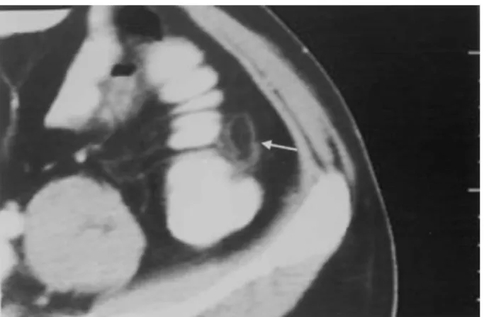 Fig. 2. MRI of the same patient with epiploic appendigitis. T 1 -weighted breath-hold spoiled gradient echo (SGE) images (TR/TE/FA, 190/4,2/80) with 6 mm section thickness in axial plane (a), reveals high signal lesion with a thin hypointense rim (arrow) a