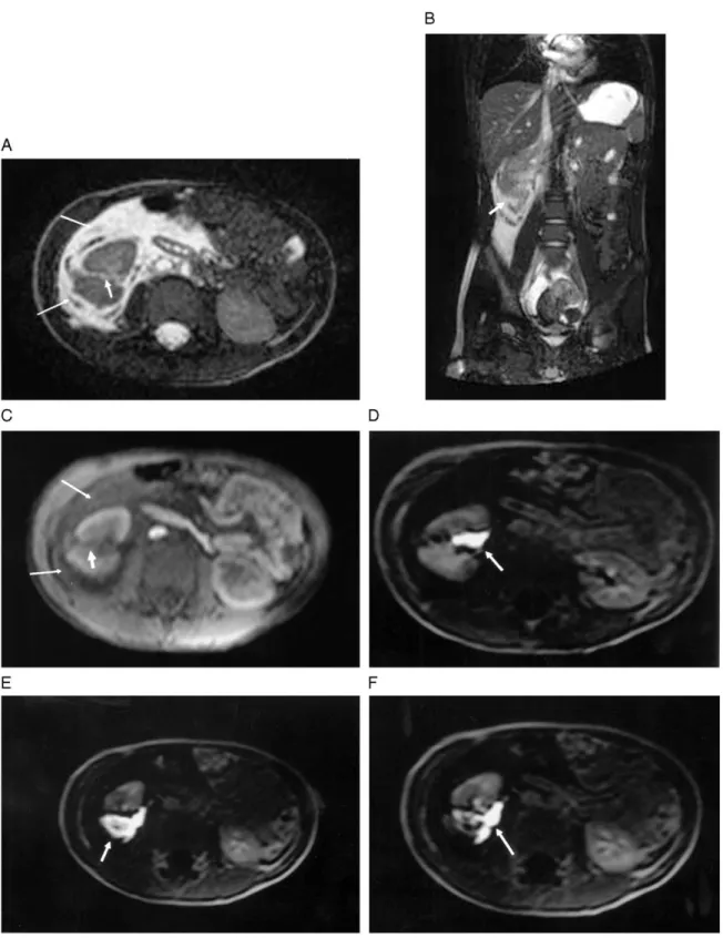 Fig. 2. Renal laceration secondary to acute blunt abdominal trauma. Axial (A) and coronal (B) T2-weighted balanced fast field echo images (TR/TE/FA, 4.8/2.1/ 70) showing perinephric fluid with a hyper/hypointense mixed signal (thin long arrows, A) and the 