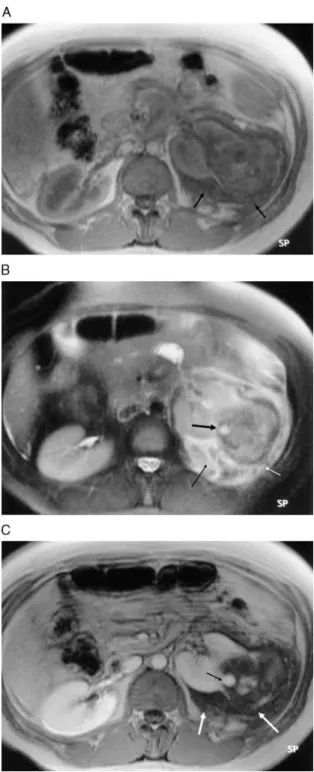 Fig. 3. Perinephric fluid extravasation as a result of the biopsy of cystic renal cell carcinoma