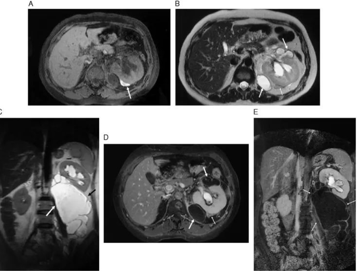 Fig. 4. Urinoma formation secondary to traumatic perirenal rupture of a long-standing hydronephrosis