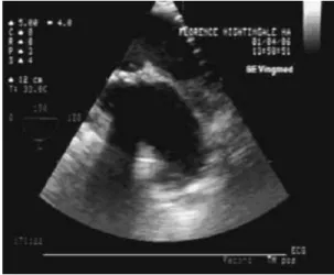 Figure 4. TEE confirmed complete ductal closure intraoperatively.