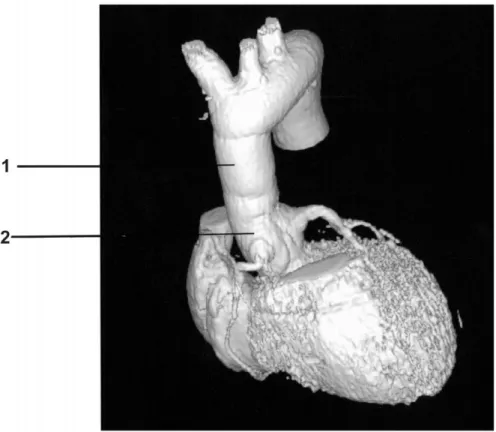 Fig. 1. (1) Dacron graft used to extend the freestyle valve; (2) freestyle valve used as a total root.