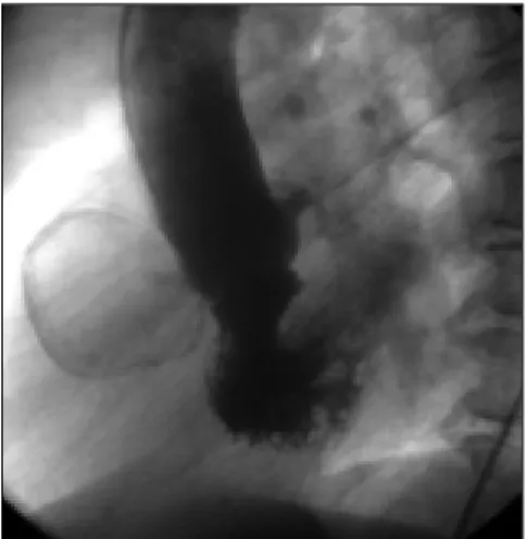 Figure  2.  Right  anterior  oblique  view  of  coronary angiogram  shows  a  giant  right  coronary  artery aneurysm at the proximal portion