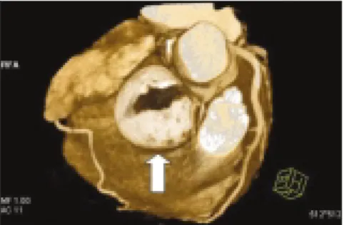 Figure 4. Coronal T2-weighted image of the thorax demonstrates the large spherical mass