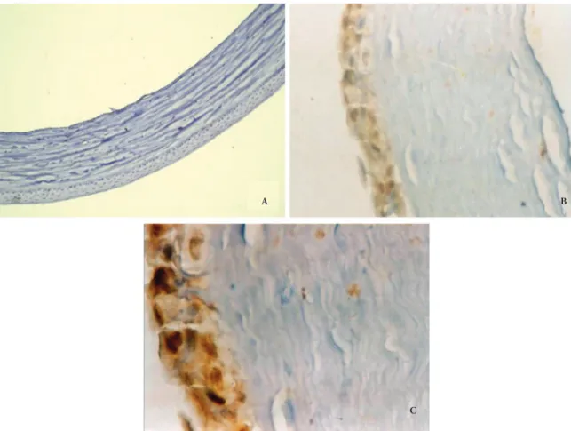 Figure 1. Anti-VEGF staining pattern in corneal epithelium; A- Score 0 (Anti-VEGF, ×100), B-Score 2 (Anti-VEGF, ×200), C- Score 3 (Anti-VEGF, ×400).