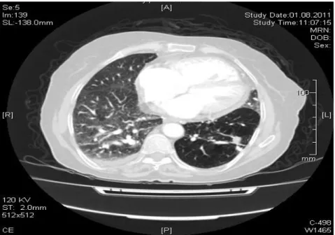 Figure III: Evidence of emphysema and air trapping on transverse section of CT images