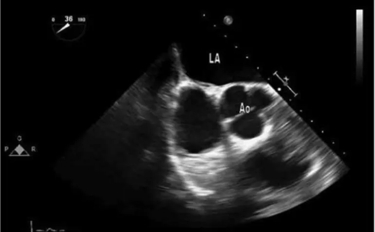 Figure 4. Basal short axis view showing echogenic mass attached to  the interatrial septum at the septal puncture site in case 2