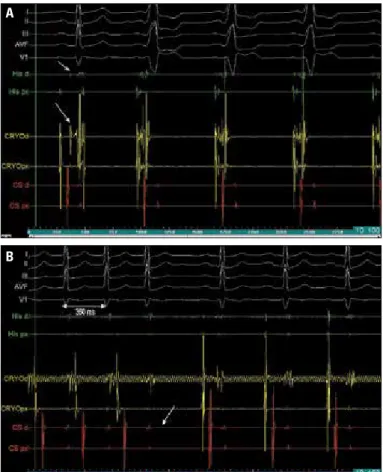 Figure 2. (A) Anteroseptally located accessory pathway (arrows point  the His deflection) showing intermittent pre-excitation