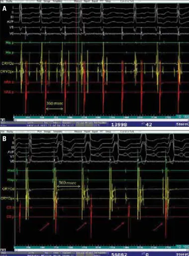 Figure 4. (A) After the ablation procedure, the Wenckebach cycle  length was 360 msec and there was no sign of anterograde accessory  pathway conduction