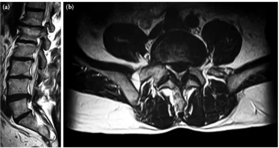 Figure 2. (a) Sagittal plane (b) Axial plane magnetic resonance imaging shows extruded right  sided L 4-5  disc herniation.