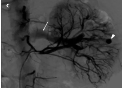 Figure 1. a–e. Axial CT angiography image  (a) of a 31-year-old male patient shows 