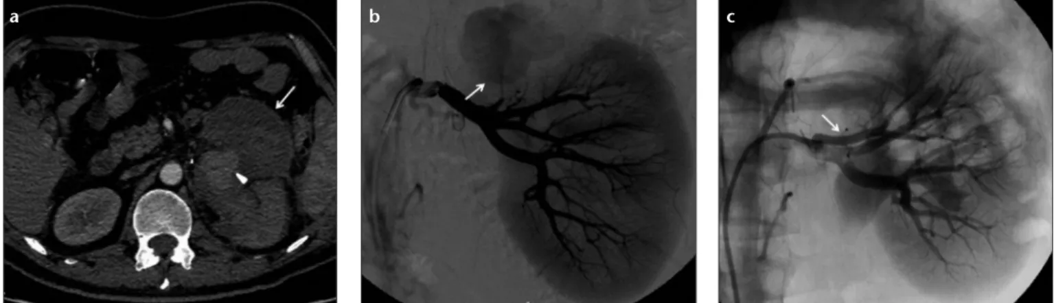 Figure 3. a–c. Axial CT angiography image (a) of a 43-year-old male patient shows a pseudoaneurysm (arrowhead) in the left kidney, which occurred 