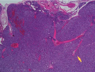 Figure 2. This parathyroid adenoma shows a rim of atrophic parenchyma at he periphery with only an attenuated capsule noted (H&amp;E, x40)