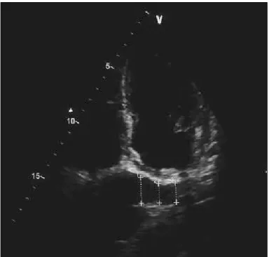 Figure 1. Echocardiographic measurements of coronary sinus are  shown
