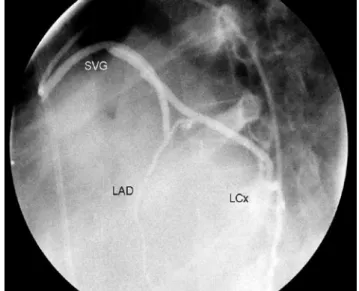 Fig.  1.  Catheter-induced  left  main  coronary  artery  dissection  with antegrade extention to left anterior descending and  circum-flex