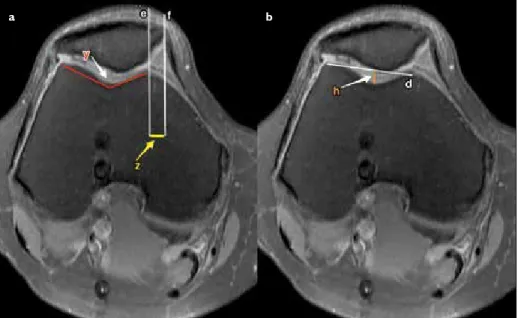 Figure 2. a, b. Sagittal (a) and axial (b) T2-weighted MR images show Insall–Salvati index and lateral  patellofemoral angle measurements