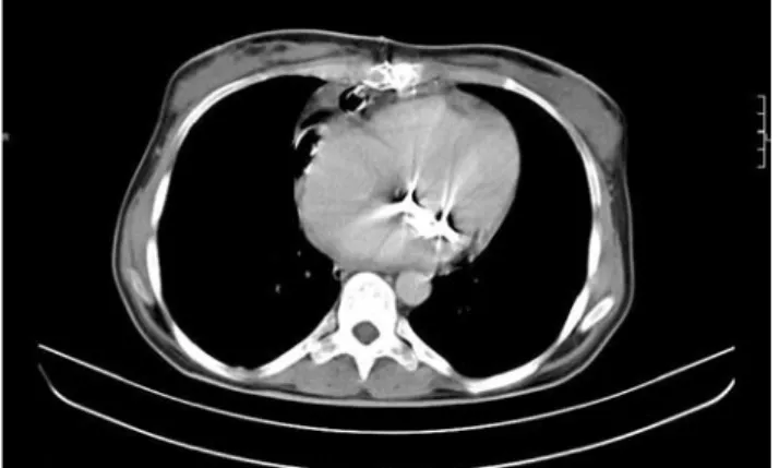 Fig. 1. Thoracal computed tomography imaging  showing the hy- hy-podense collection 20x30x80 mm in size in thymic localization  in the anterior mediastinum.