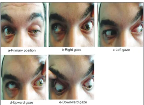 FIGURE 1: The primary position and the movements of right and left eyes of the patient.