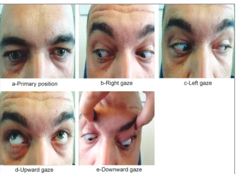 FIGURE 3: The primary position and the movements of right and left eyes of the patient after three months.