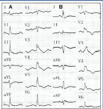 Figure 1.  Sisters IA and IB electrocardiograms. Normal si- si-nus rhythm. T wave inversions in V1 to V6