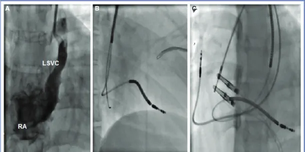 Figure 3.  (A) AP projection demonstrating a LSVC. (B) RAO 30° view demonstrating lead advanced into  the coronary sinus via a PLSVC, and an active fixation RV lead directed into the apex