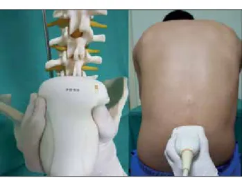 Figure 1. Positioning of the ultrasound probe for the transverse  median approach