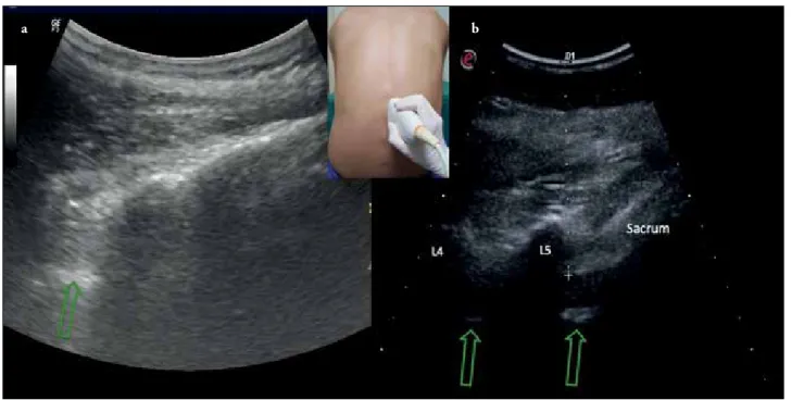 Figure 7. a, b. (a) Sacrum is usually seen as a hyperechoic flat or wedge-shaped structure (b) The exact vertebral interspace can be  determined by counting vertebrae caudad-to-cephalad direction starting from the sacrum