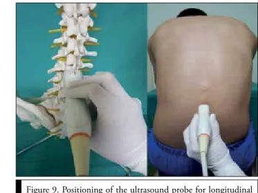 Figure 9. Positioning of the ultrasound probe for longitudinal  median scanning