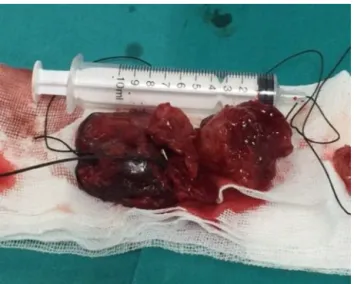 Figure 3 Macroscopic appearance of the tumor.