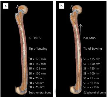 Figure 3. Reference angles of the distal femur in the sagittal plane. ACA: Anterior cortical axis; the line that connects the points drawn at 5 cm and 10 cm proximal to the distal joint line on the anterior  cor-tex