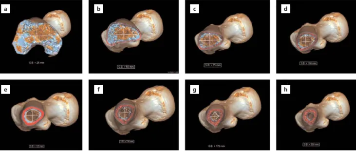 Figure 5. Measurement of canal diameters from distal end of the Blumensaat line level towards the proximal part in the coronal (a) and sagittal (b) planes
