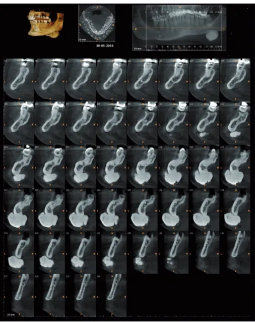 FIGURE 1: Preoperative CBCT.