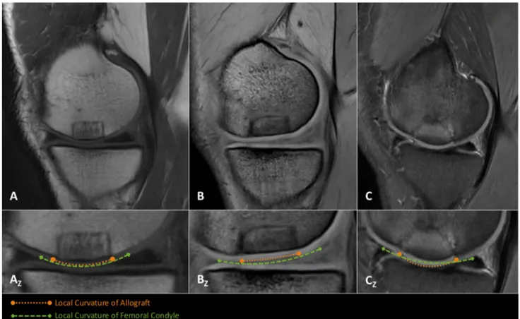 Fig. 1    From the analysis of the magnetic resonance imaging (MRI)  data, (a) a sagittal MR image of a patient with curvature index match  between the graft and condyle region and (A Z ) a drawing of the  local curvature cartilage margins of the condyle a