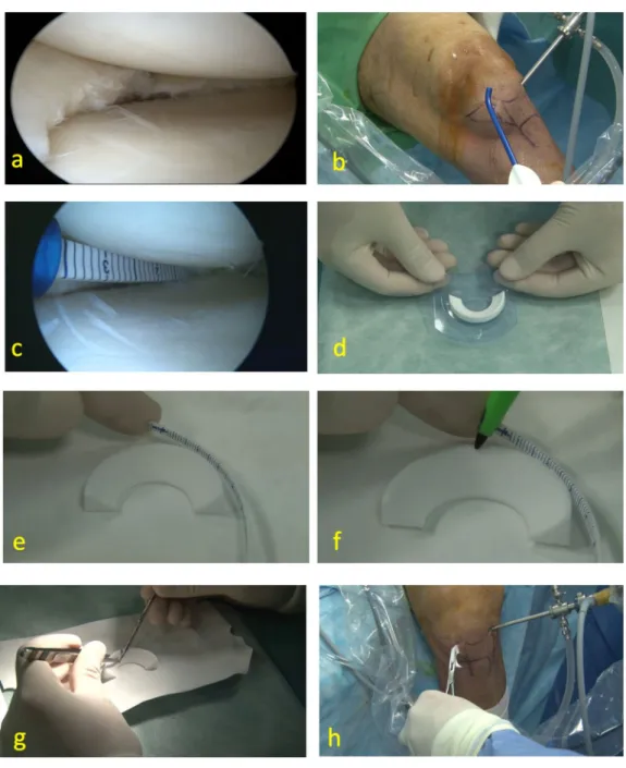 Fig. 1    Preparation steps of meniscus scaffold implantation. a Arthro- Arthro-scopic view of medial meniscus defect