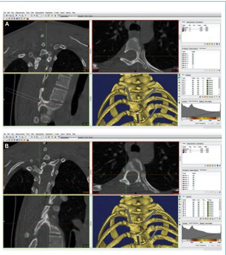 Figure 2. (A) Pedicle screw trajectory of the left pedicle of T5 is visible on