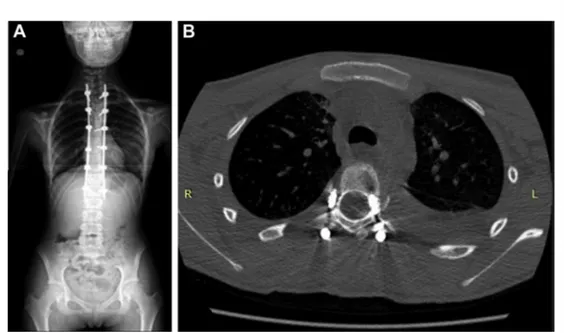 Figure 4. ( A) Postoperative anteroposterior standing plain radiograph of the same patient as shown in Figure 1