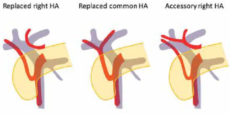 Figure 1. Three commonly encountered types of aberrant hepatic artery arising from the  superior mesenteric artery.