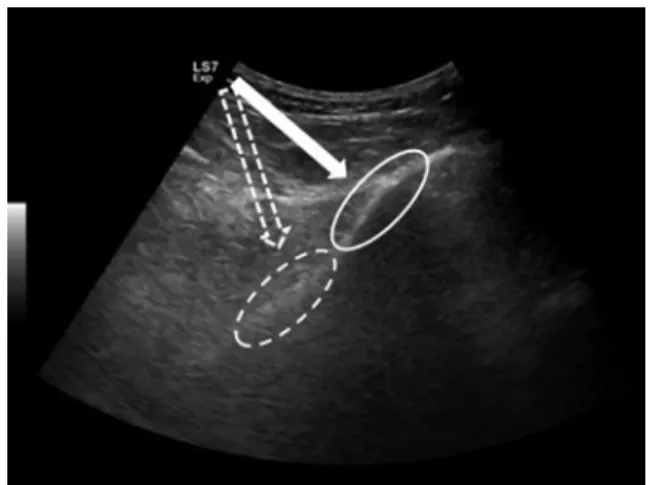 Fig. 1. Axial US image shows the brachial artery (a) and basilic vein (v) in the cubital fossa (left side)