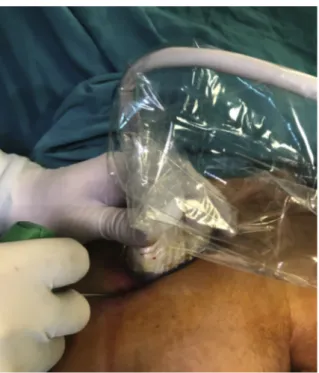 Fig. 6. Placement of the US probe (covered with a sterile sheath) and advancement of the trocar using the in-plane technique.