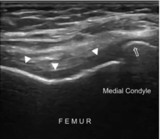 Fig. 11. Longitudinal US imaging of the suprapatellar bursa shows anechoic effusion and synovial thickenings/hypertrophy (asterisks) in a patient with knee osteoarthritis.