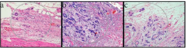 Figure 1. H&amp;E  stained  sections  of  gastric  adenocarcinoma:  a)  PDC Grade 1, b) PDC Grade 2, c) PDC Grade 3 (X100)