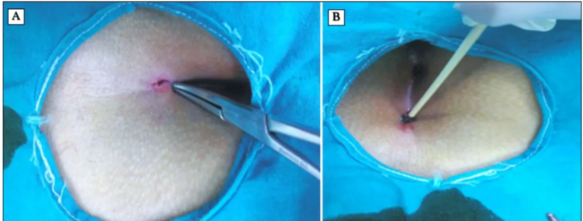 Figure 1. (A) Sinus orifice is expanded with a mosquito clamp, and content of the sinus tract including hair and debris is cleaned